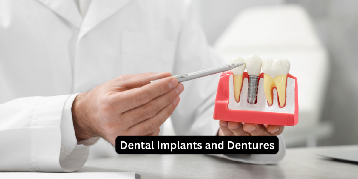 Dental Implants and Dentures: A Comprehensive Guide