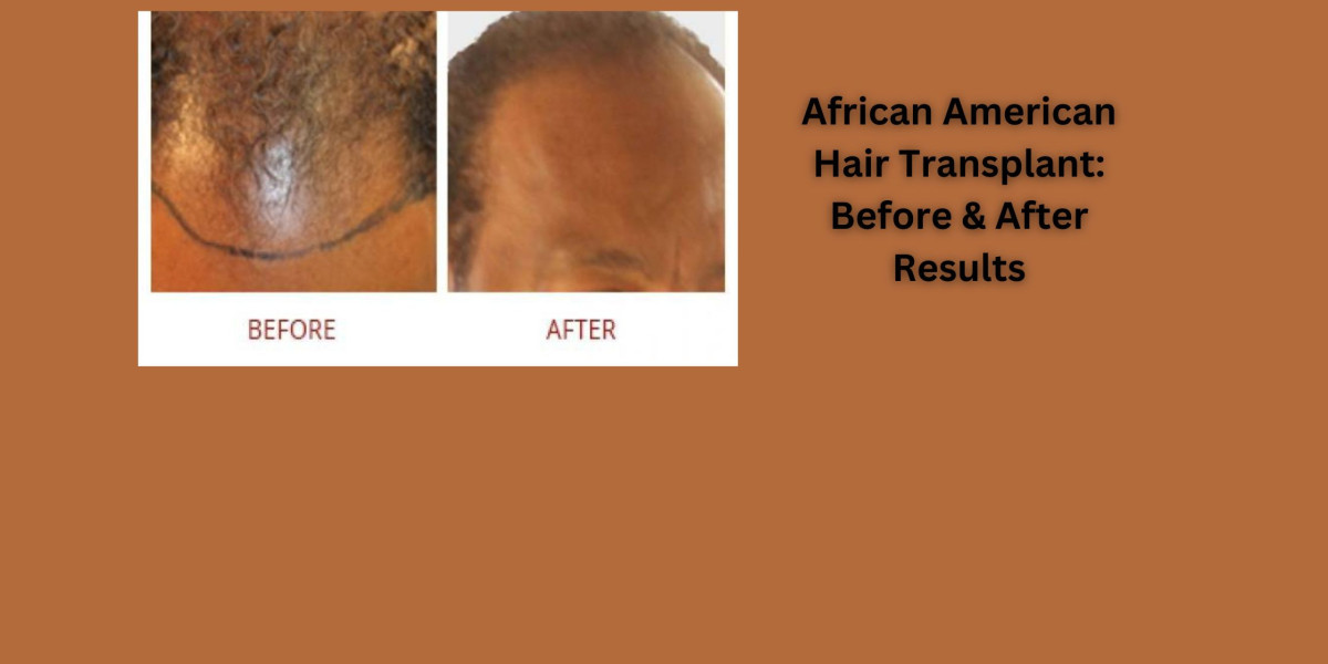 African American Hair Transplant: Before & After Results