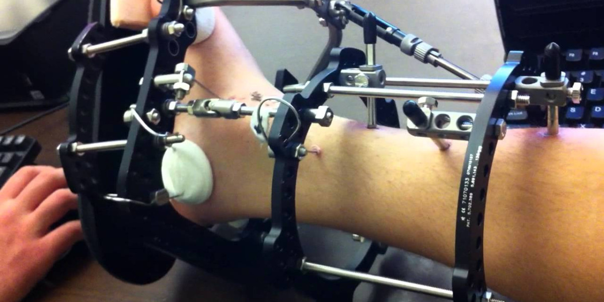 Stabilizing Recovery: Trends in the Trauma Fixation Device Market