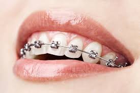 Orthodontic treatments bundoora, Watsonia, Reservoir & Greensborough