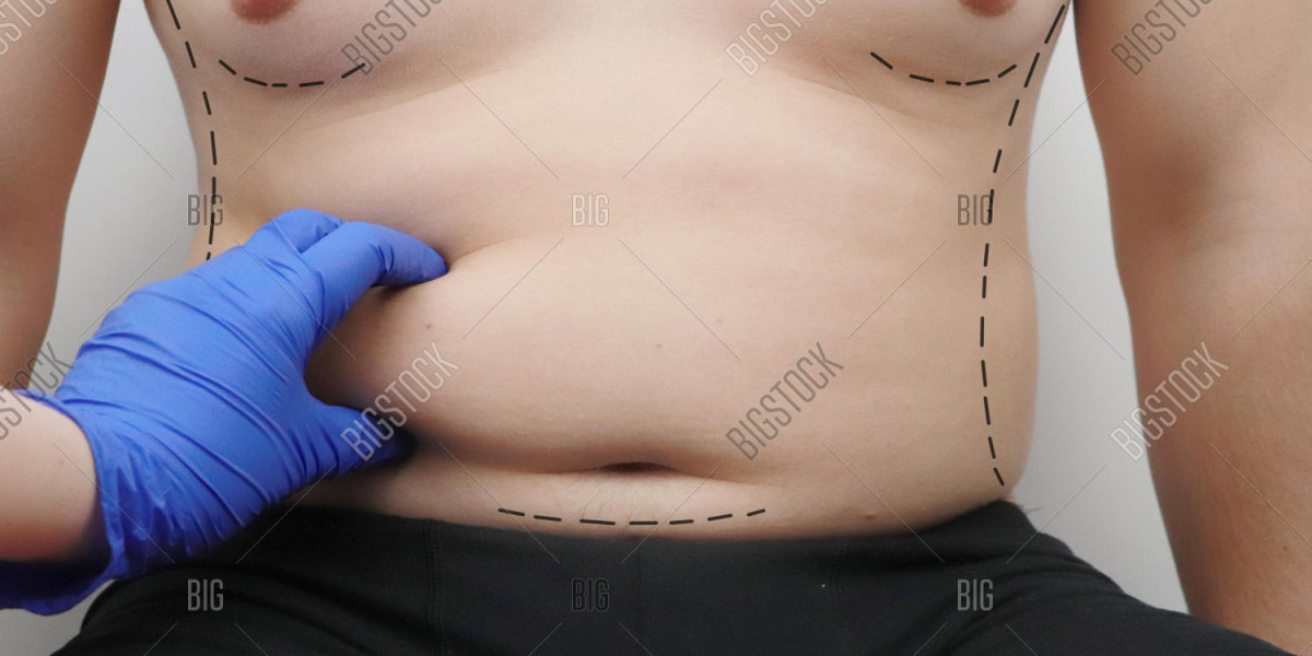 Tummy Tuck Surgery in Islamabad – Complete Guide