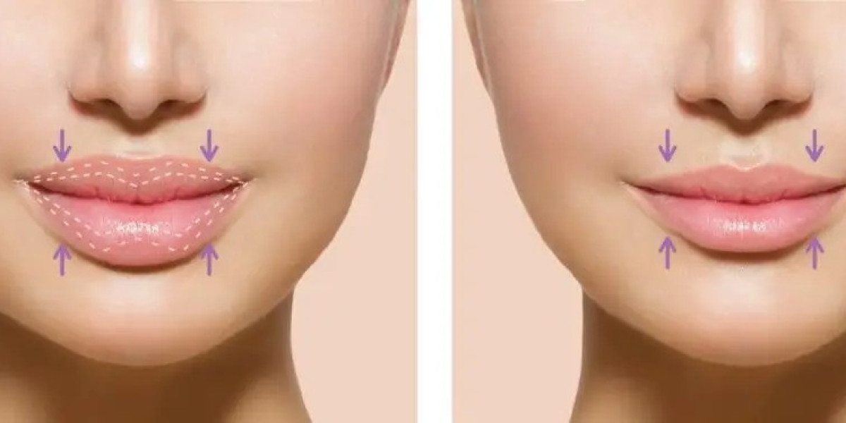 Lip Reduction in Islamabad: Complete Treatment Guide